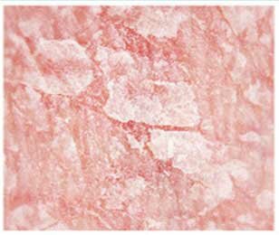 Шелушащаяся кожа